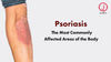 Psoriasis treatment : The Most Commonly Affected Areas of the Skin