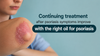 Continuing treatment after psoriasis symptoms improve with the right oil for psoriasis